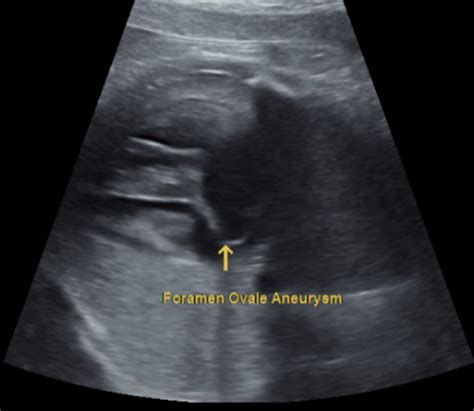 Fetal Foramen Ovale