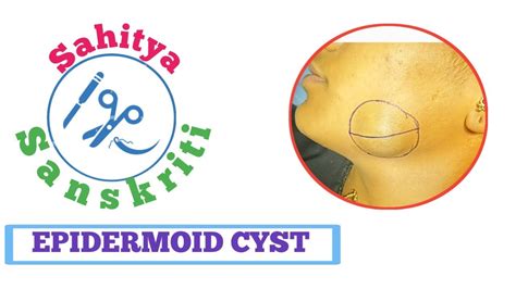 Epidermoid Cyst Dermoid Cyst Cyst Youtube