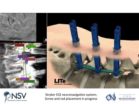 Advanced Spinal Instrumentation Images C N S Neurosurgery