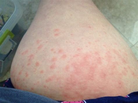 Pruritic Urticarial Papules And Plaques Of Pregnancy Puppp Rash