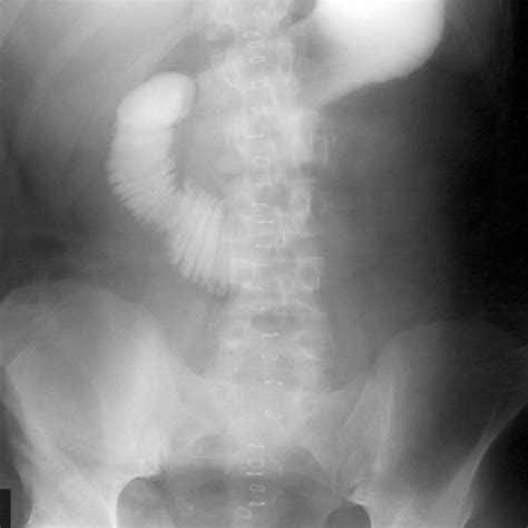 Gastrografin Small Bowel Contrast Enema On Th Postoperative Day