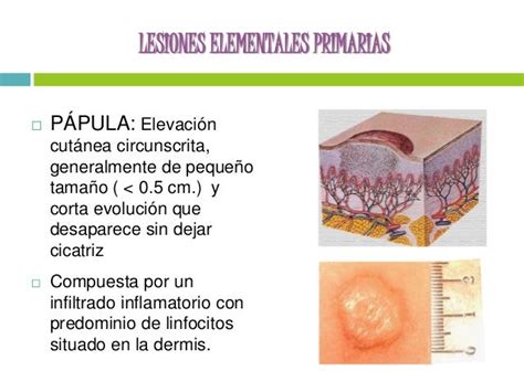 Lesiones Elementales De La Piel Primarias Y Secundarias