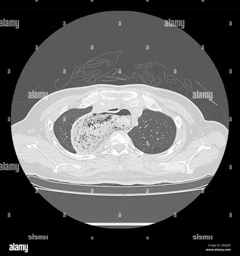 Achalasia of the oesophagus, CT scan Stock Photo - Alamy