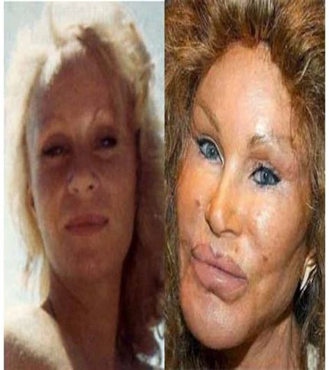 Of The Worst Celebrity Plastic Surgery Disasters Hot Sex Picture