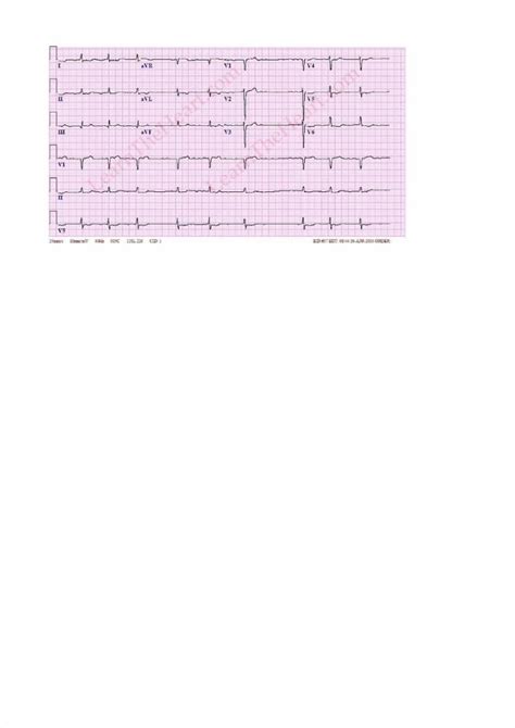 Pdf Latihan Ekg Baca Dokumen Tips