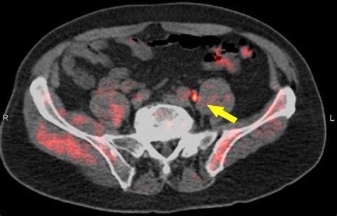 Fused PET CT 18F Fluciclovine IMAGE EurekAlert Science News Releases