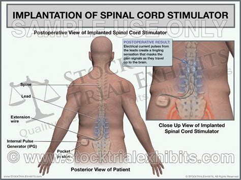 Lumbar Spinal Cord Stimulator Implantation Trial Exhibit Male Stock