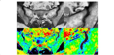 Magnetic Resonance Imaging Of The Sacroiliac Joints Of A 42 Year Old Download Scientific