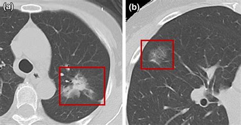 Pulmonary Nodule On Chest Ct A Thin Section Ct With 3 Mm Collimation Download Scientific