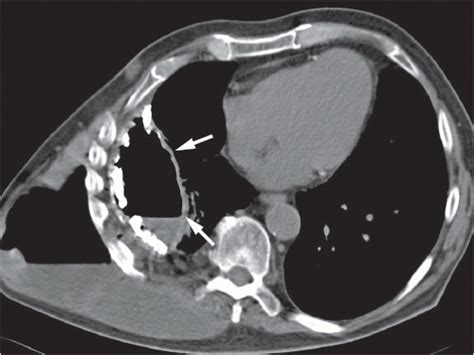 Diseases Of The Chest Wall And Diaphragm Radiology Key