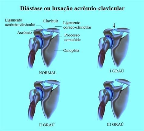 O Que Luxa O Acr Mio Clavicular O Que Fazer