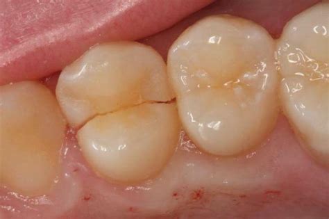 E Se Houver Fissuras Nos Dentes Causas E Tratamento