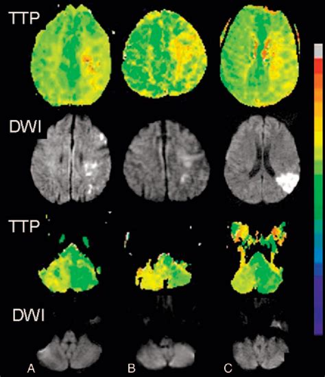 Table 1 From MR Perfusion Imaging Detected By Dynamic Susceptibility