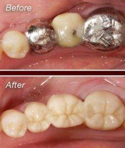 Zirconium-Crown-Before-and-After-253×300 | Partners in Dental Health