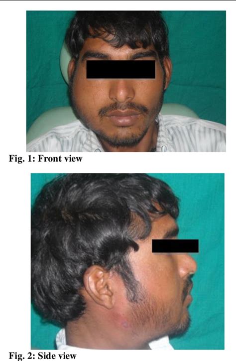 Figure From Odontogenic Keratocyst Of Mandible With An Unusual