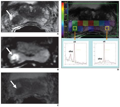 61 Year Old Man With Prostate Cancer A Axial T2 Weighted Image Shows