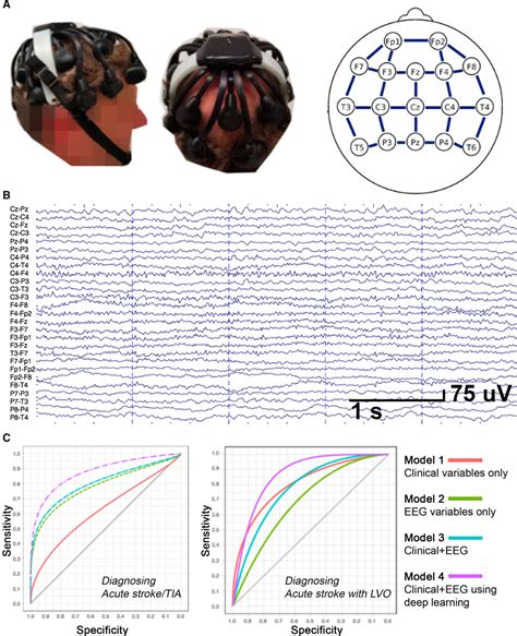 Electroencephalography Might Improve Diagnosis Of Acute Stroke And