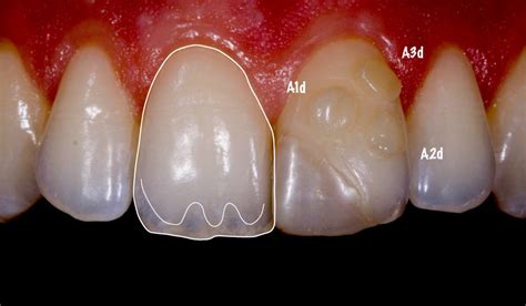 Highly Aesthetic Class Iv Composite Restoration