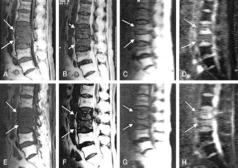 Diffusion Weighted Mr Imaging Of Metastatic Disease Of The Spine