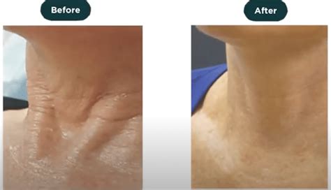 Neck Rejuvenation Procedures Treatments Sydney Contour Clinics