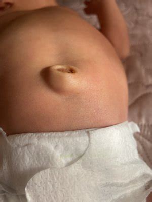 Hernia Umbilical Beb Babycenter