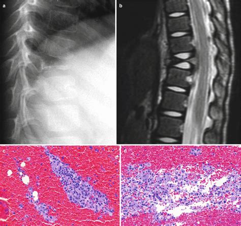 Langerhans Cell Histiocytosis Musculoskeletal Key