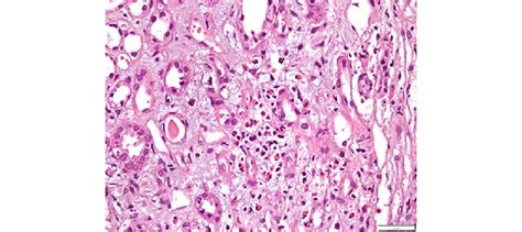 Neutrophilic And Eosinophilic Interstitial Infiltration Download Scientific Diagram