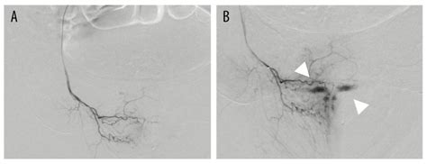 American Journal Of Case Reports A Case Of A Refractory Bleeding Giant Vaginal Wall Cavernous