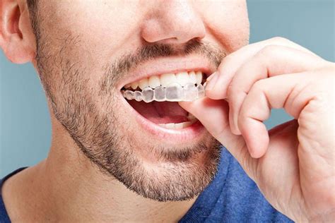 Conheça as etapas do tratamento alinhadores Invisalign