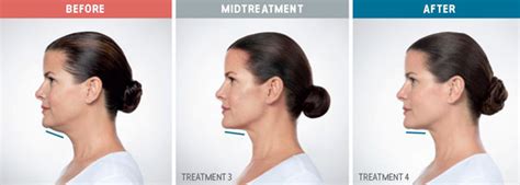 Kybella® Central Oregon Dermatology