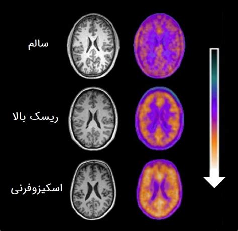 اختلال اسکیزوفرنی چیست و علائم اولیه آن چیست بهمن ۵ ۱۴۰۳