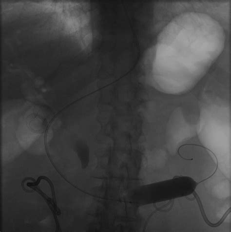 Dilation Balloon Occlusion Technique For Eus Guided Gastrojejunostomy