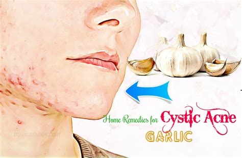 37 Natural Home Remedies For Cystic Acne On Face