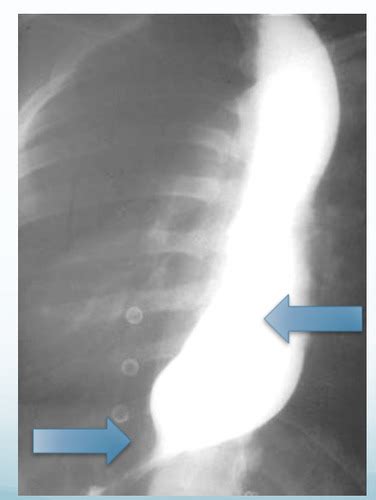 Y Gi S W Disorders Of The Upper Gi Tract Flashcards Quizlet