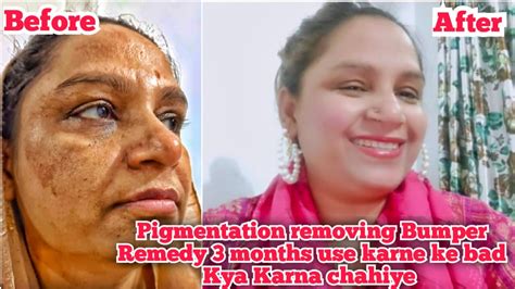 Pigmentation Removing Bumper Remedy Months Use Karne Ke Baad Kya