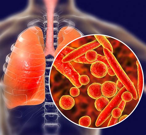 Pneumonia Sintomas Tipos E Como é O Tratamento Br