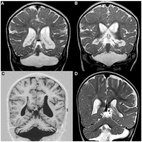 Examples Of Mri Scores Of Cerebellum A And B Cerebellar Hemisphere Download Scientific