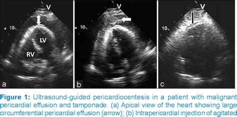 Pericardiocentesis Ultrasound Guided