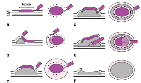 7 Technique Used For Endoscopic Submucosal Dissection A Mucosal Download Scientific Diagram