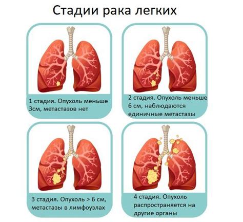 Рак легких - стадии и виды