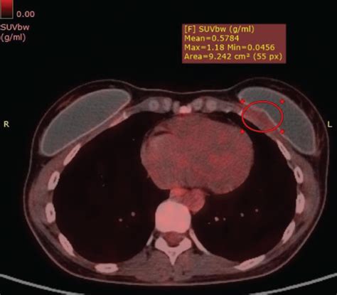 Intracapsular Sigbic Imaging Findings In A 40 Year Old Woman With Left Download Scientific