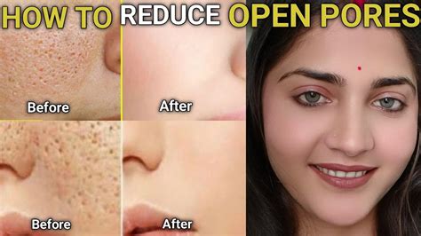 How To Treat Your Open Pores😍 😌💯 Ll Open Pores Ll Large Pores Ll 💯