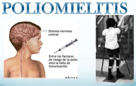 Poliomielitis Historia Tipos Y Tratamientos Red Diversidad Funcional