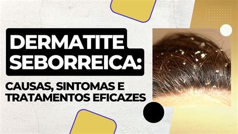 Dermatite Seborreica Causas Sintomas E Tratamentos Eficazes YouTube