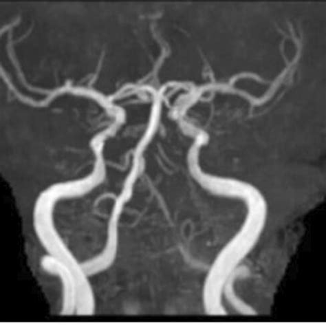 Representative Magnetic Resonance Angiography Images Of Intracranial