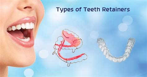 Various Types of Teeth Retainers Available Online & Their Usage ...