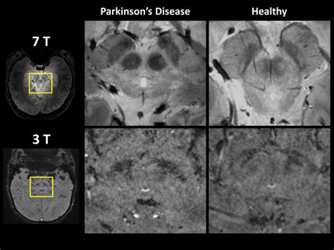 Comparison Of Midbrain T2 Weighted Images Between Parkinsons Disease