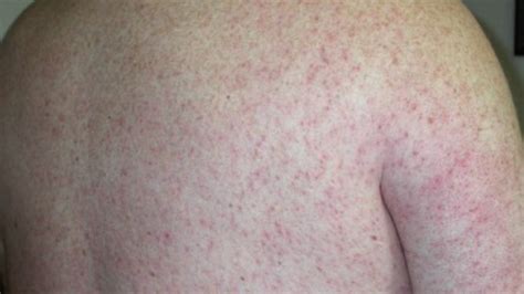 Viral Rash: Types, Symptoms, and Treatment in Adults and Babies