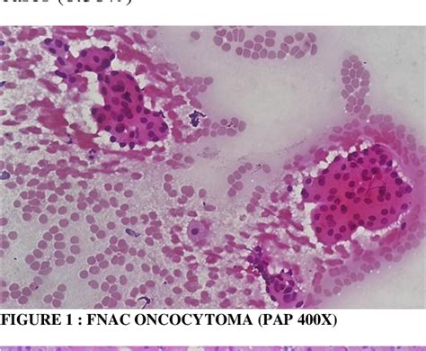 Figure 2 From Study Of Fine Needle Aspiration Cytology Of Salivary