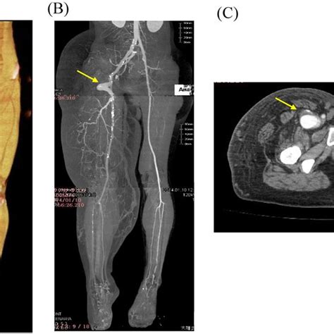 Clinical picture showing engorged tortuous varicose veins involving the... | Download Scientific ...